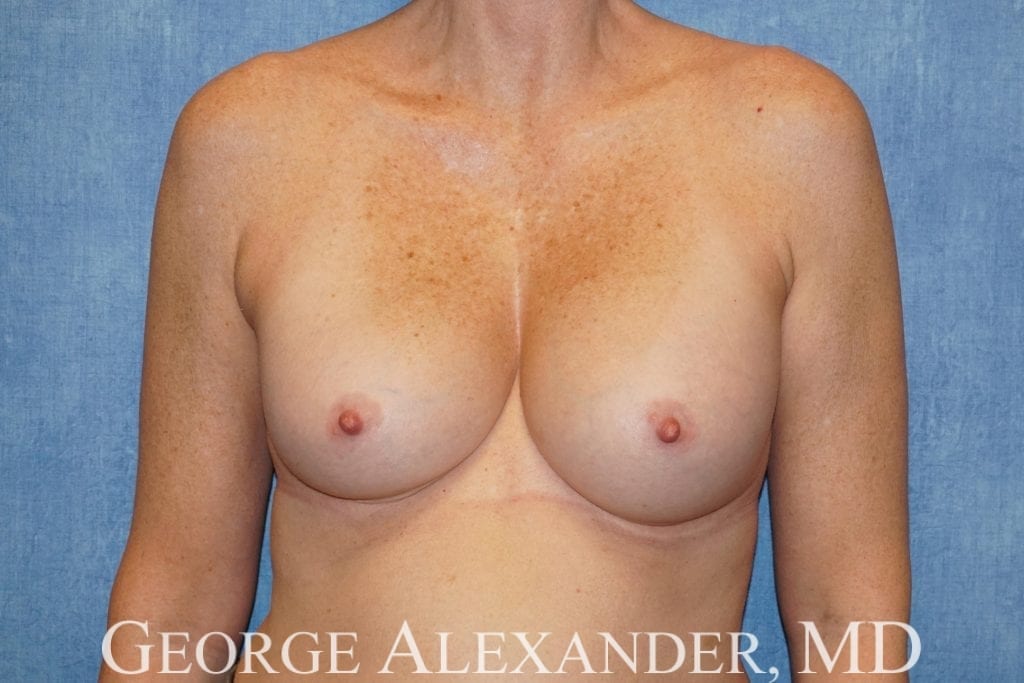 Before  Breast Implant Exchange 2