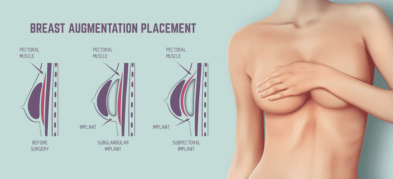 Diagram about method of insertion for breast implant