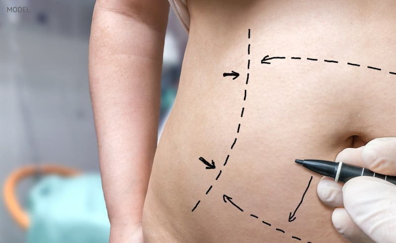 Woman preparing for a tummy tuck with surgical lines drawn on her abdomen.