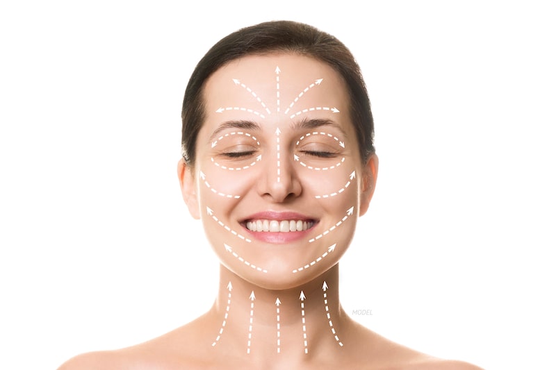 Young, smiling woman with facelift rejuvenation lines drawn on her face.