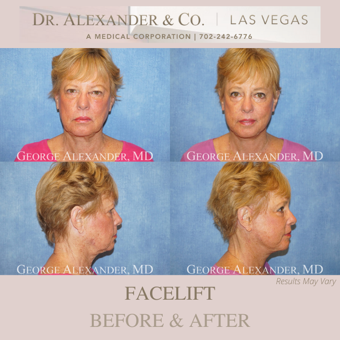 Before and after image showing the results of a facelift performed in Las Vegas, NV.