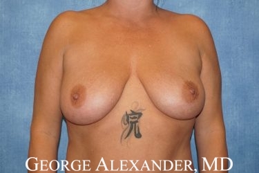 Pre Front Breast