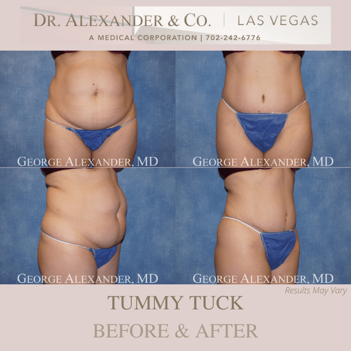 Before and after image showing the results of a tummy tuck performed in Las Vegas, NV.