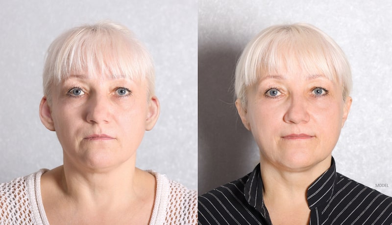 Before and after otoplasty of a middle aged woman with white hair